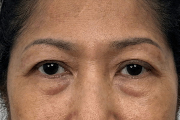 Hình ảnh bọng mắt dưới trước điều trị – Dr. Eye chuyên sâu chống lão hóa vùng mắt
